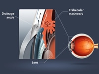 Laser Glaucoma Surgery for Eye Pressure
