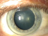 Cataract Lens Implants in Westchester