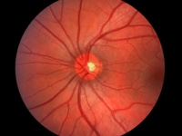 diabetic eye