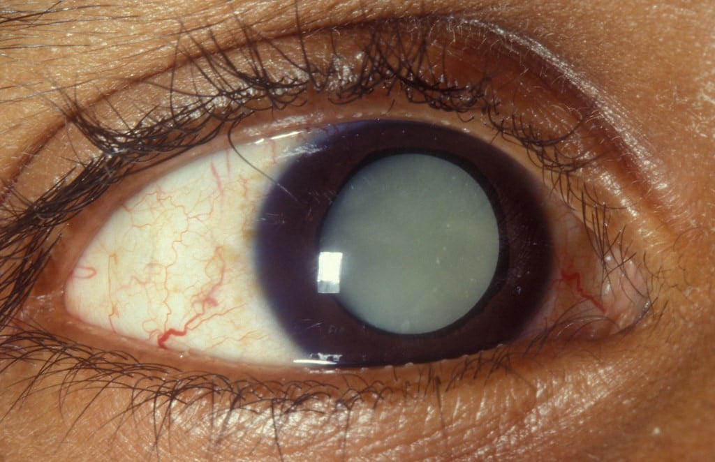 Basic Cataract Surgery Procedure